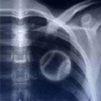 X-Ray çıkartma grafiği